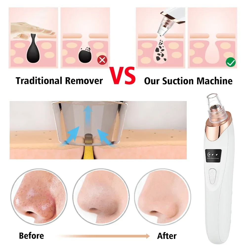 PoreRemover: Oppladbar Smart Hudormer, Hvite Hudormer Porer Fjerner Kit